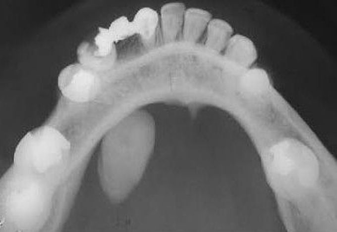 Sialolithiasis seen in occlusal radiograph