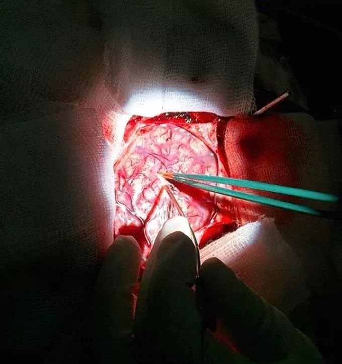 NEUROSURGERY