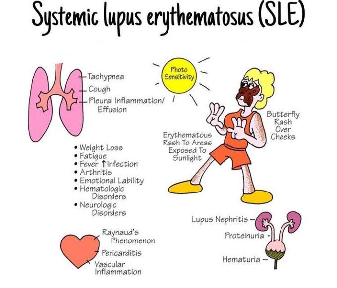 Systemic Lupus erythmatosus (SLE)