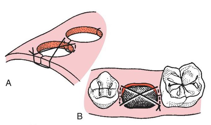 Figure of eight suture