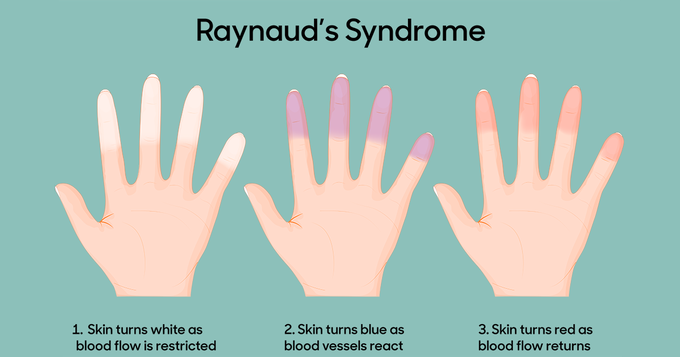 Symptoms of Raynaud’s Phenomenon