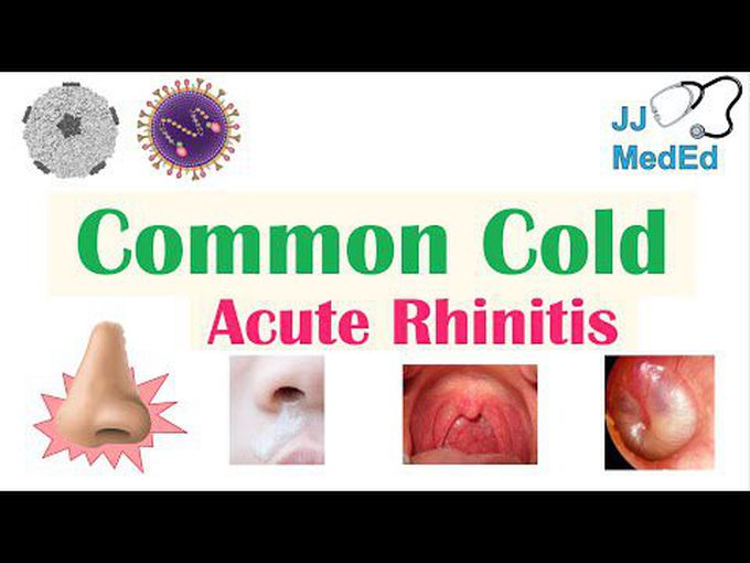 Pathology of Acute Rhinitis/Common cold