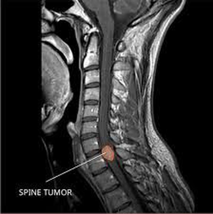 Ependymoma