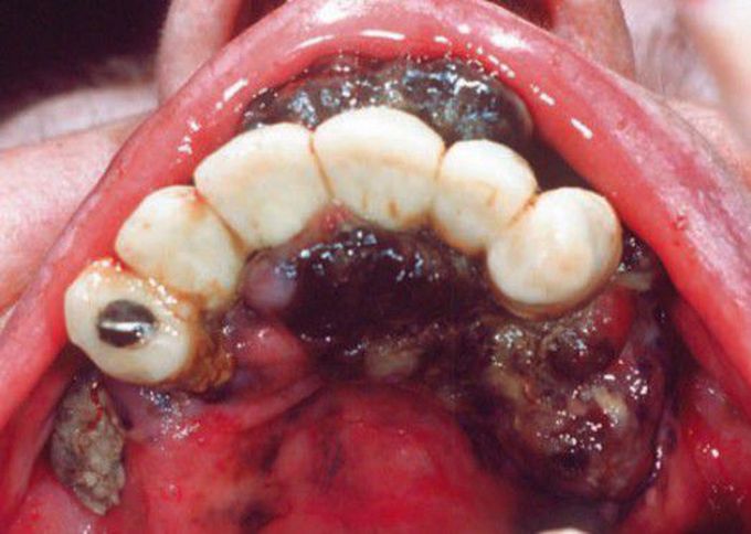 Invasive oral melanoma