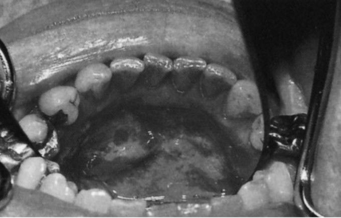 Leukoplakia