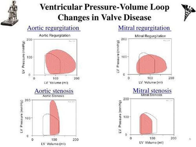 Ventricular pressure volume loop and vascular disease
