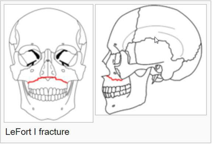 Lefort 1 fracture