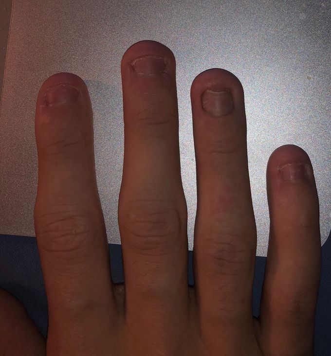 Inflated fingers