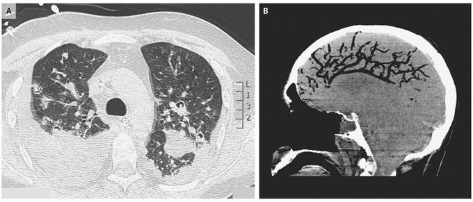 Cerebral Air Embolism