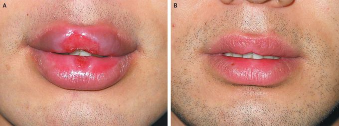 Syphilitic Chancres of the Lips