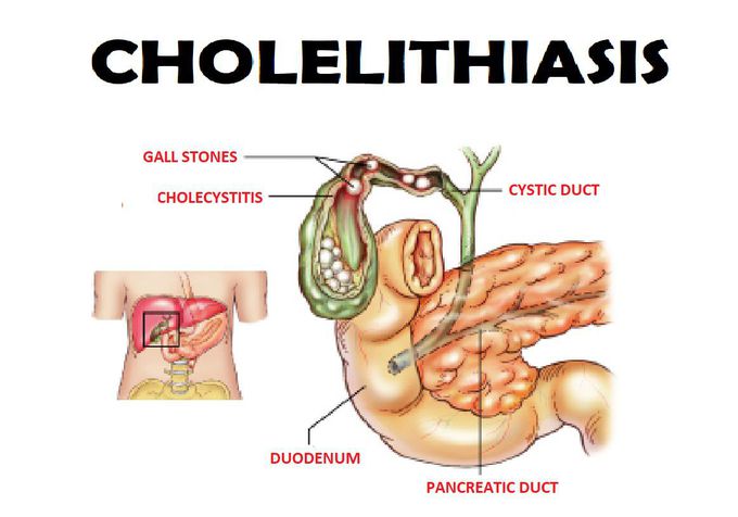 Cholelithiasis