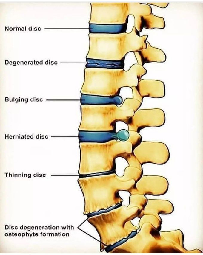 Normal Vs Abnormal Discs