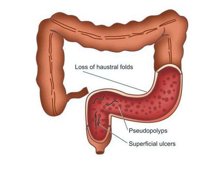 Ulcerative colitis.