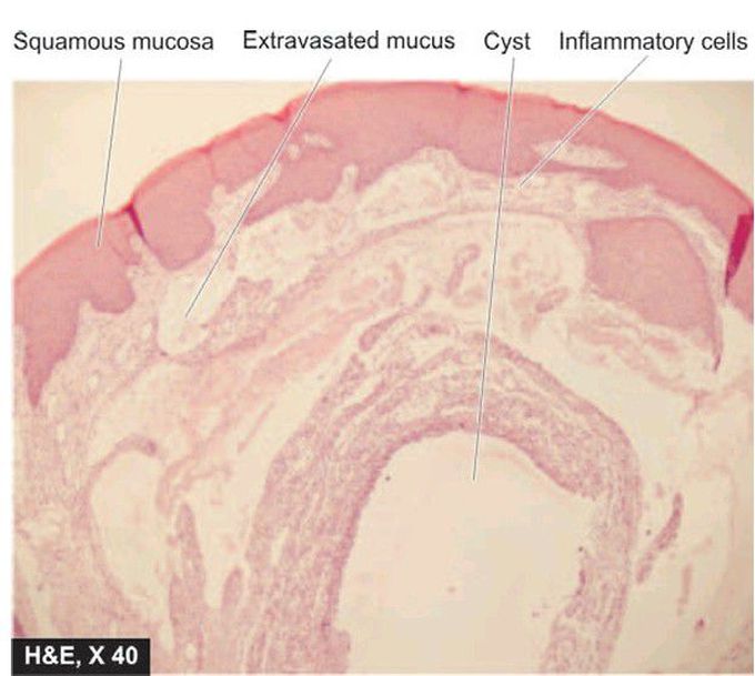 Mucous retention cyst (mucocele).