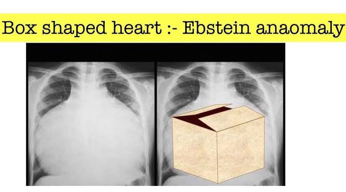 Box Shaped Heart