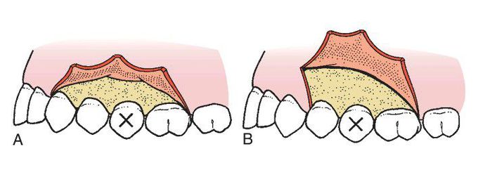 Principles of flap design