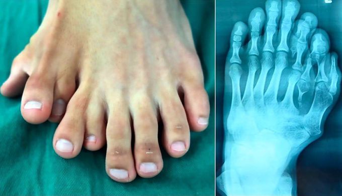 Young man born with NINE toes on one foot! 👣⁣ 
