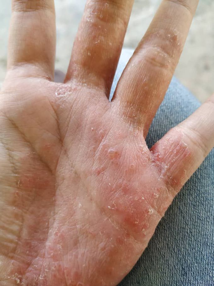Dermatitis