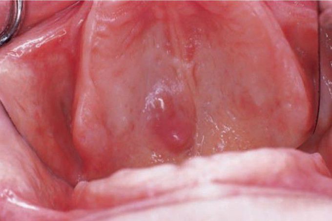 Mucocele (mucus extravasation phenomenon)