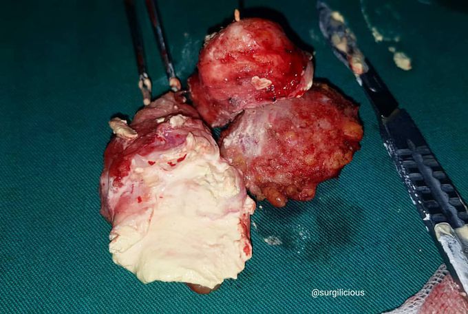 67 y.o femme with calcinosis cutis 