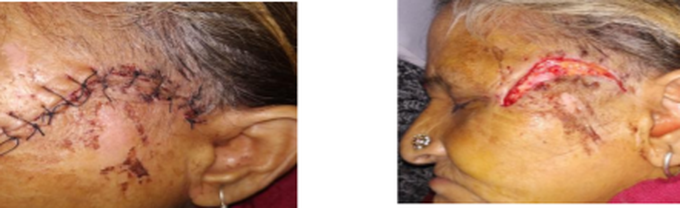 Delayed or No Healing in Maxillo-facial Trauma Secondary to Foreign Body Invasion