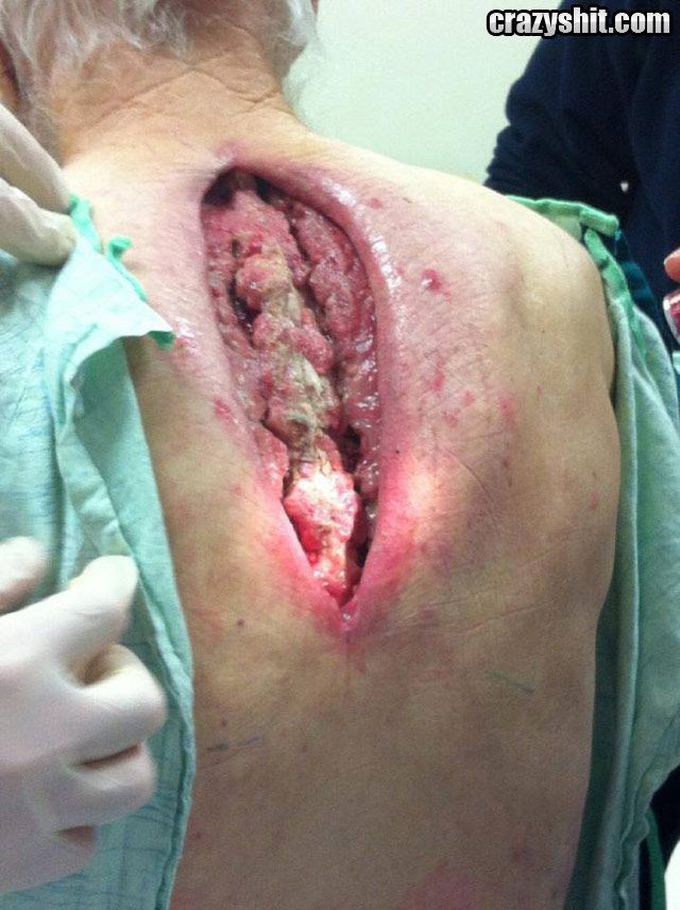 Ingrown hair, left untreated....WOW | Real life gore | Pinterest