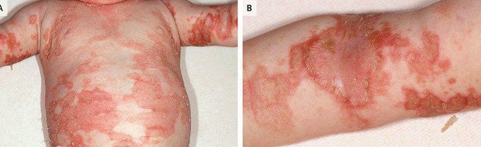 Zinc Deficiency Associated Dermatitis In 4-Month-Old Boy