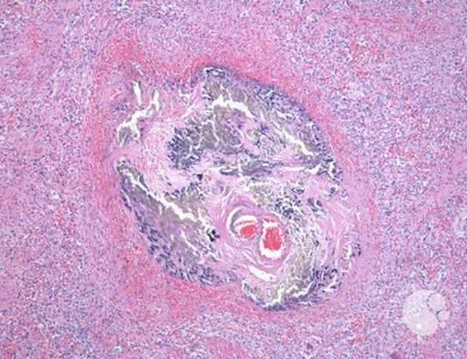 Pathology question