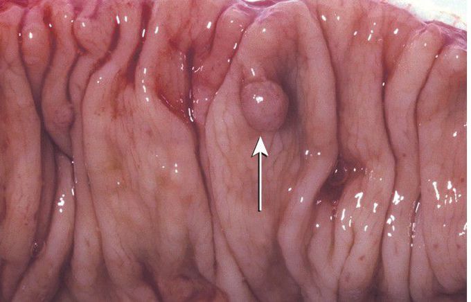 Gardner Syndrome.