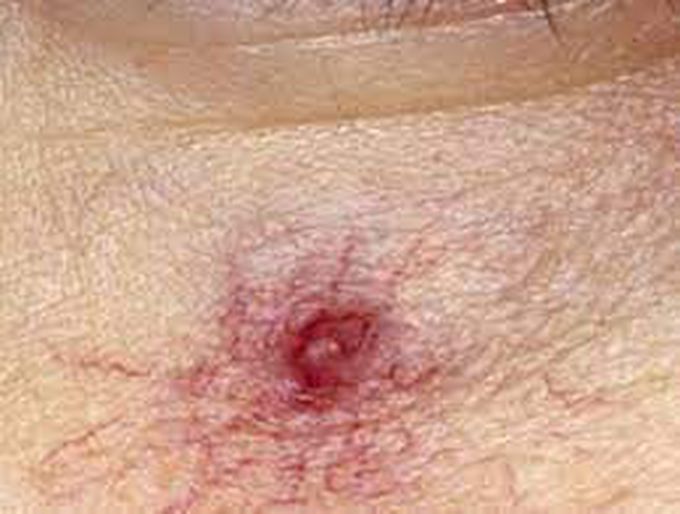 What is spider nevus?