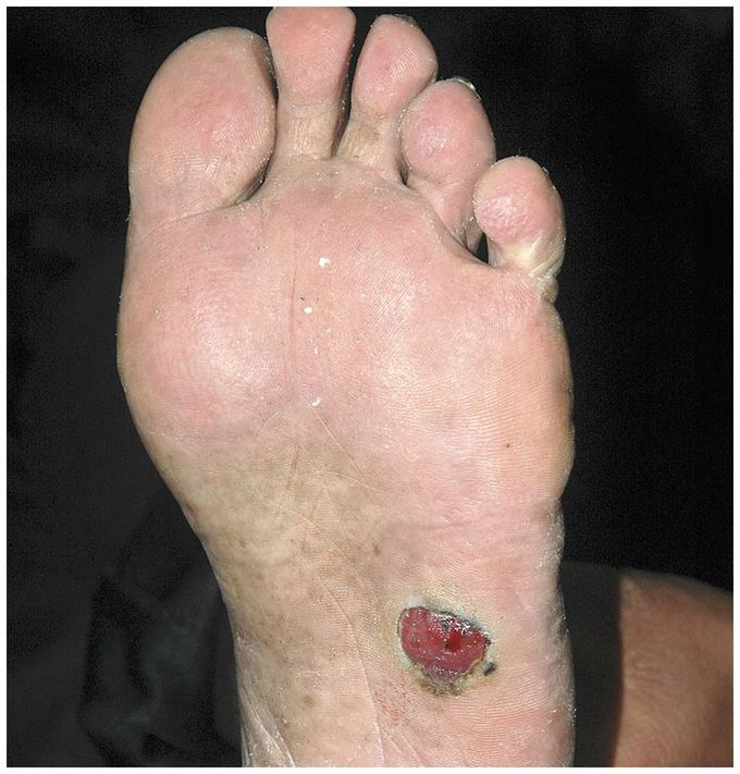 Melanoma of the Foot
