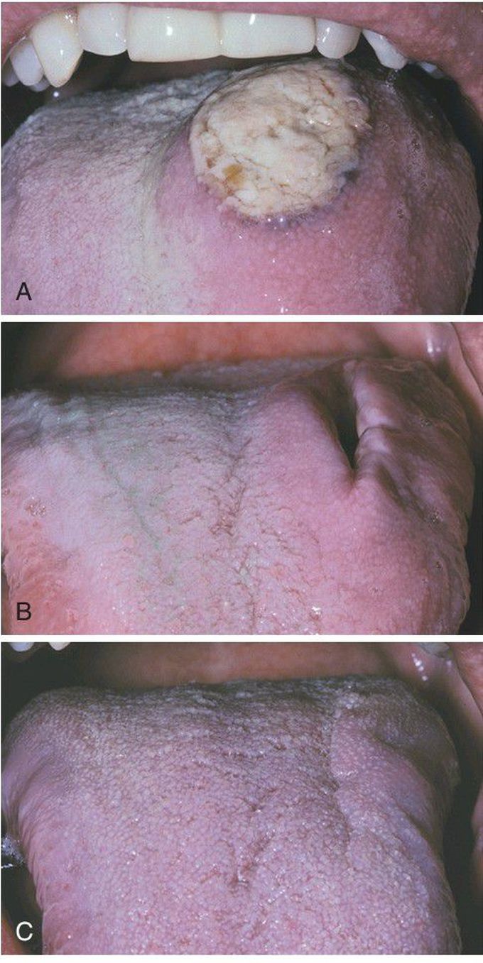 Eosinophilic Ulceration.