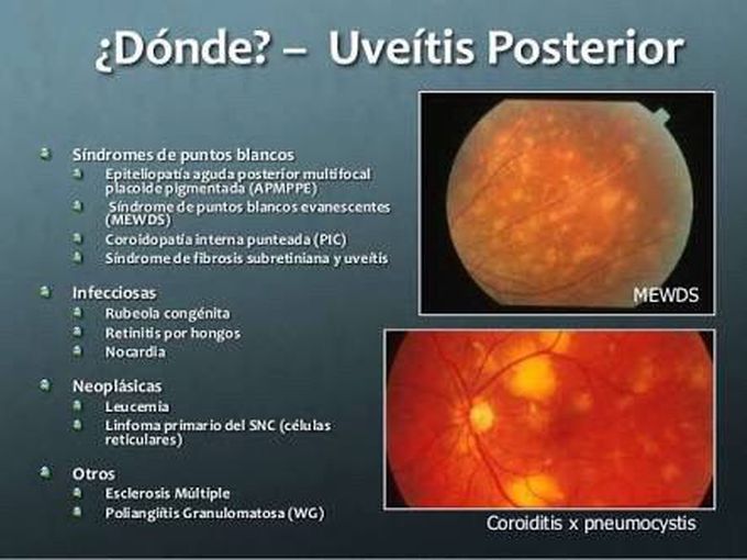 Uveitis posterior