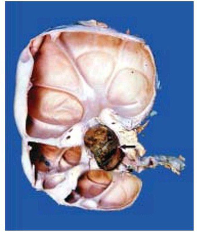 Hydronephrosis with nephrolithiasis.