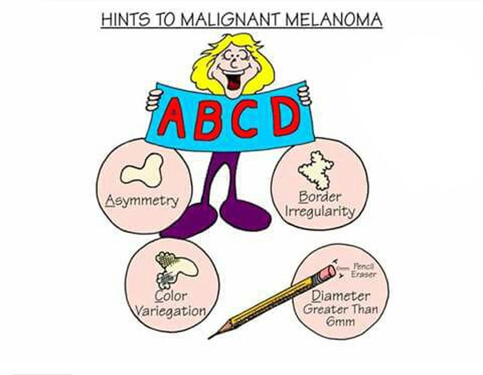 Malignant melanoma
