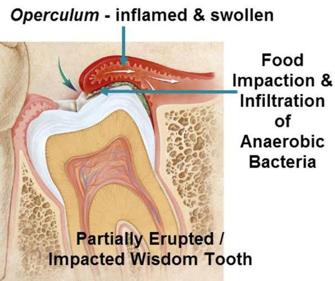 Symptoms of pericoronitis