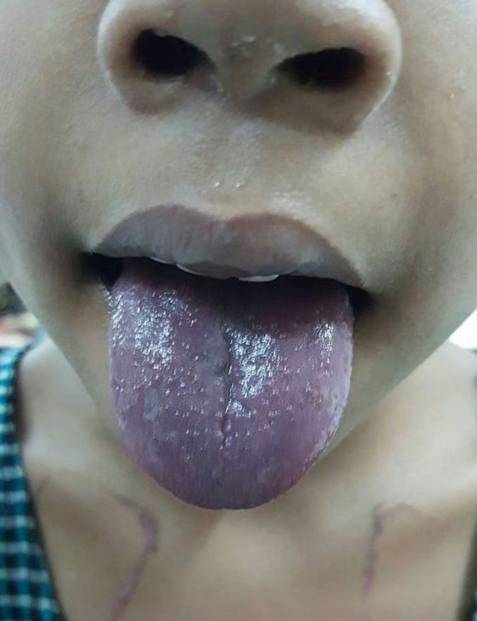 Blue tongue disease
