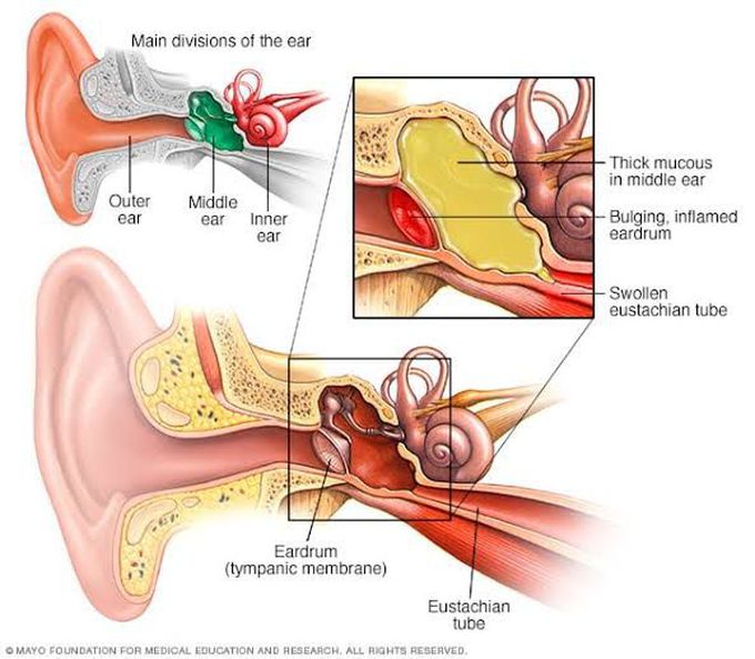 Ear infection