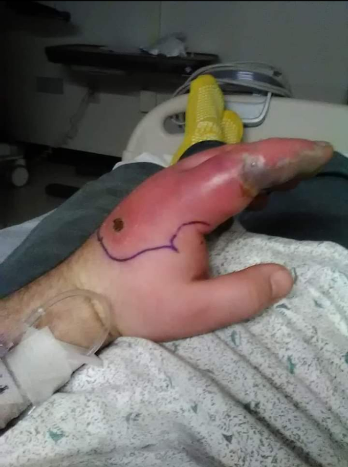 Spider Bite
