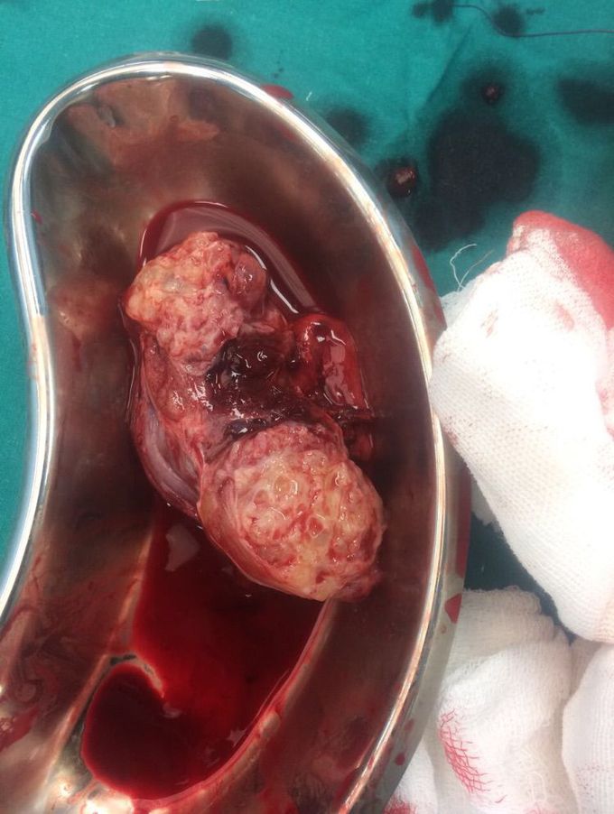Tuberculosis of testis