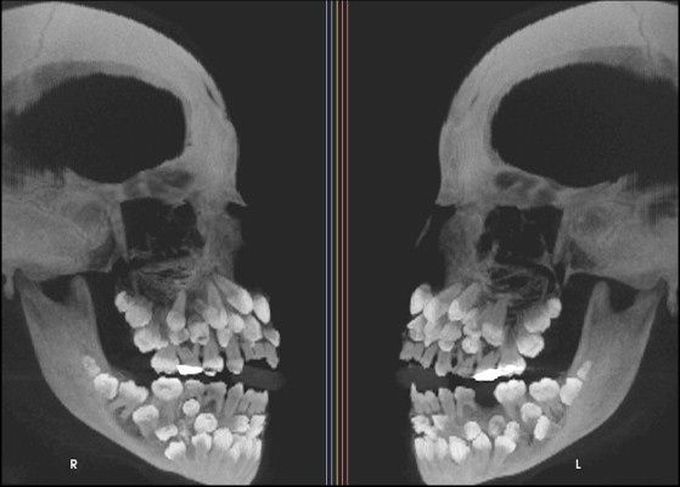 Multiple Hyperdontia