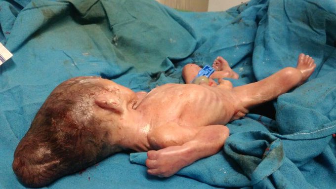 Abnormal birth