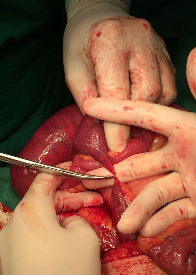 Oclusion intestinal