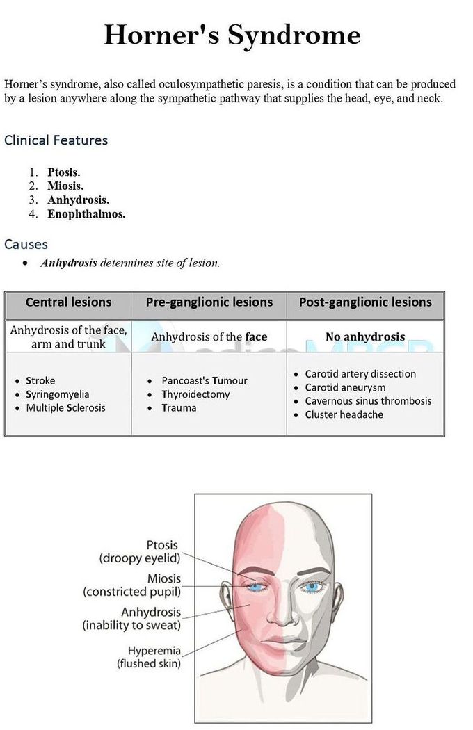 Horner's Syndrome