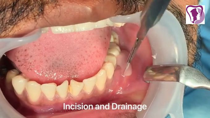 contraindications of incision and drainage