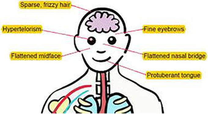 These are the symptoms of Tricho-hepato-eteric syndrome