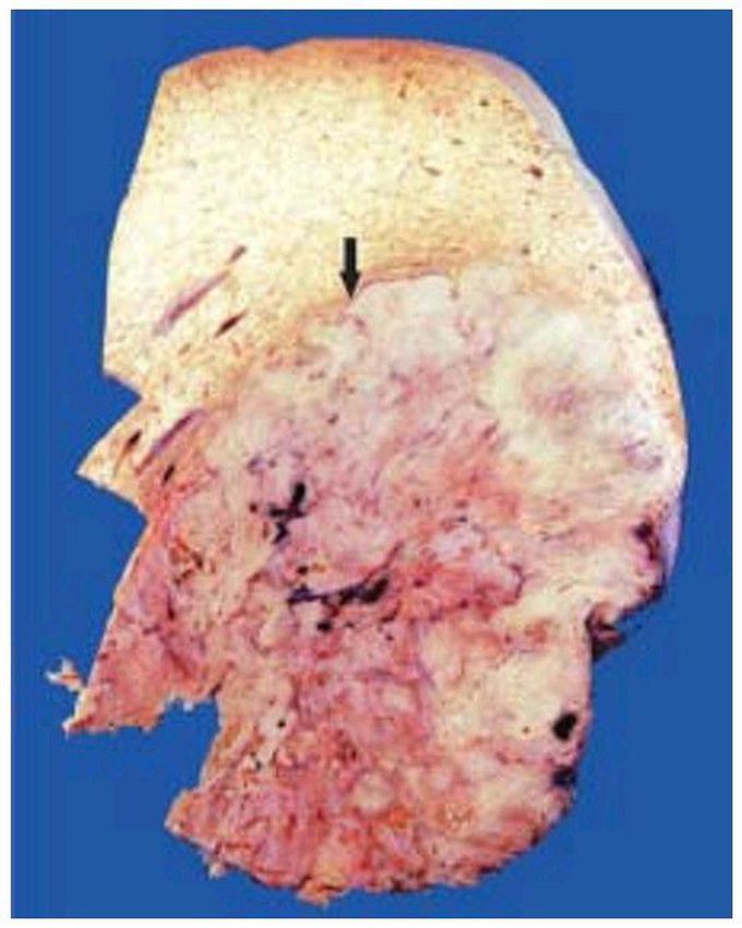 Hepatocellular carcinoma