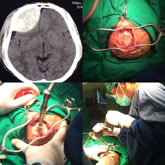 Craniectomy decompression on extradural hematoma 