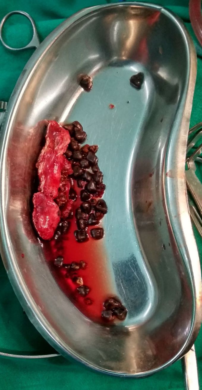 Mixed Stones of Gallbladder