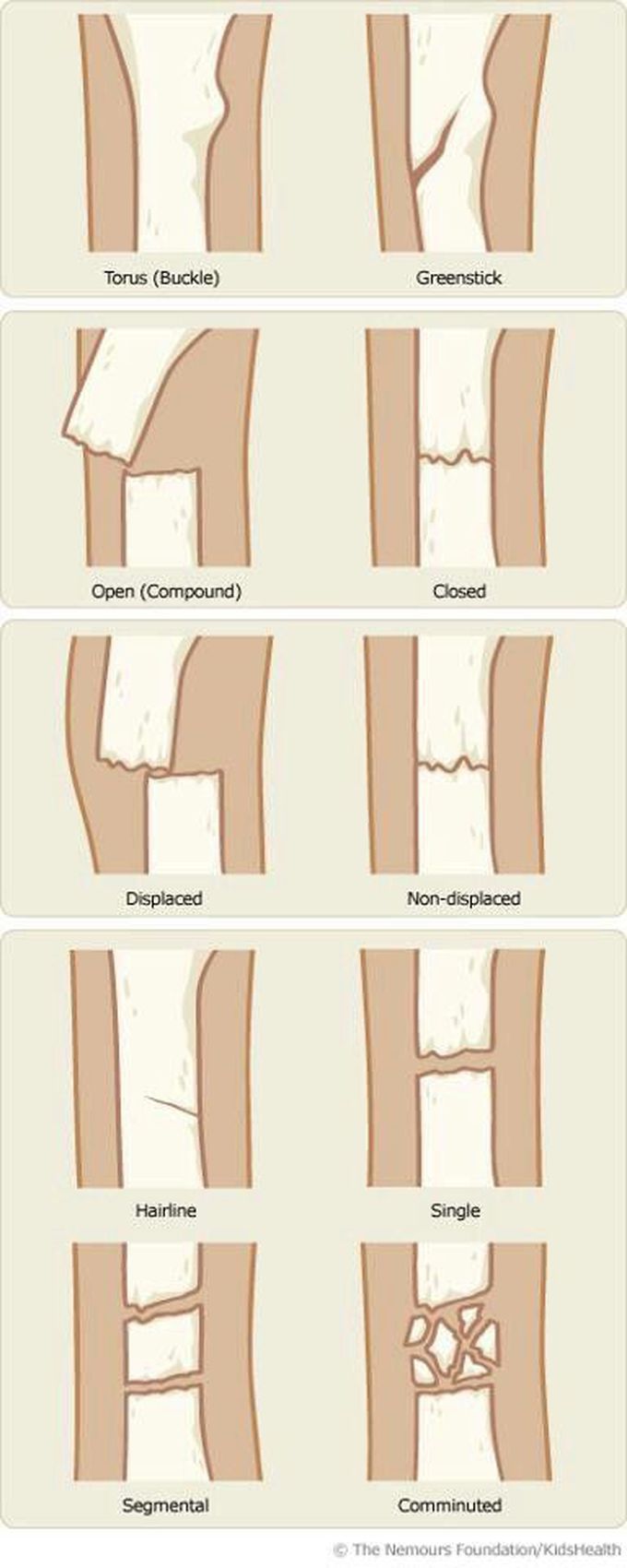 Common fractures